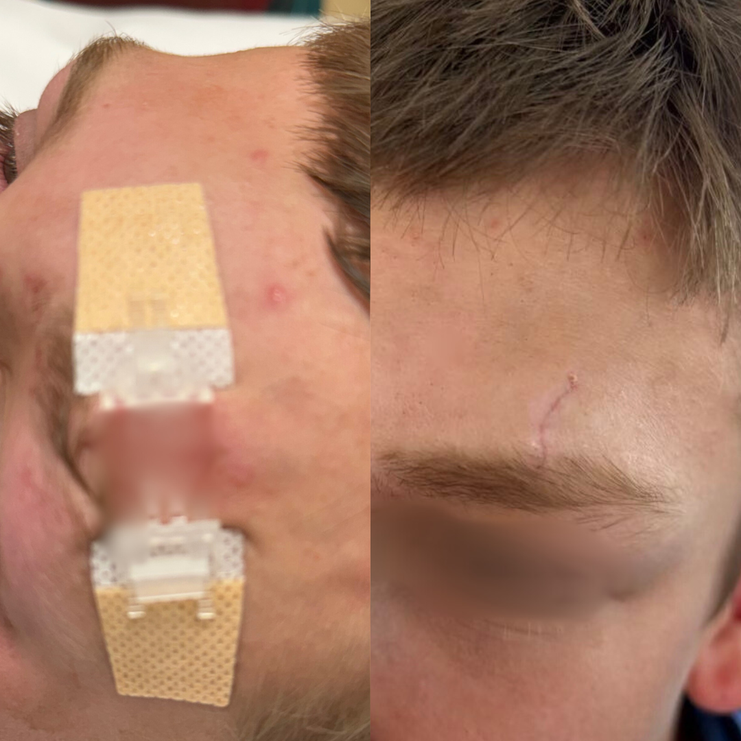 Ventra™ Advanced ZipClose Stitches