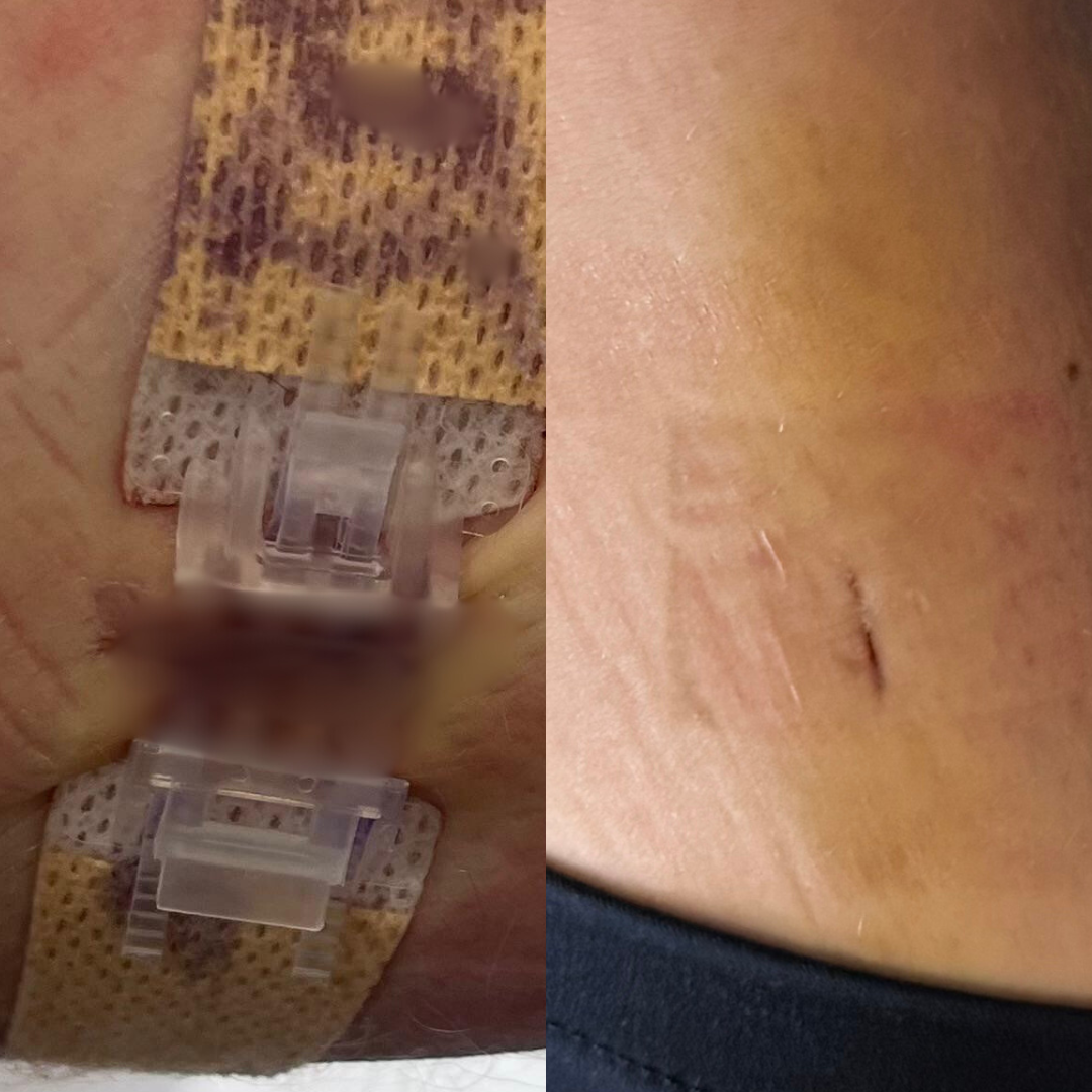 Ventra™ Advanced ZipClose Stitches
