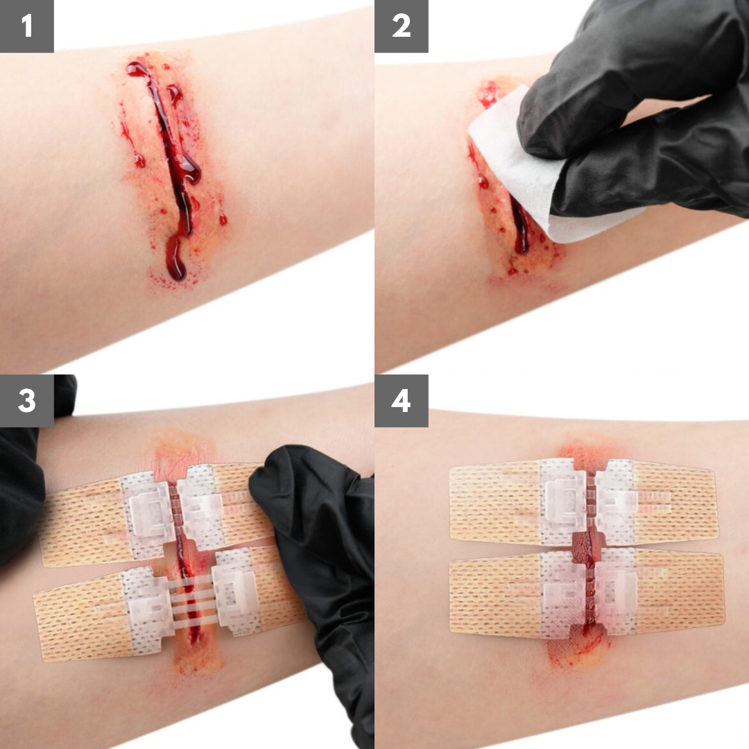 Ventra™ Advanced ZipClose Stitches